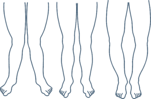 Ski-Trucks-Boot-Fitting-Foot-Analysis